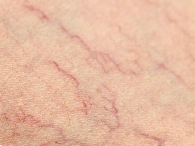 Tratamentul venelor varicoase în arzamas pe - Recenzii ajutai lezele cu vene varicoase